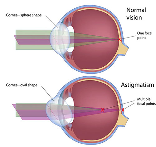 Astigmatism Treatment in Bayside