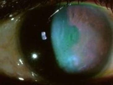 Eye Surgery Bayside
