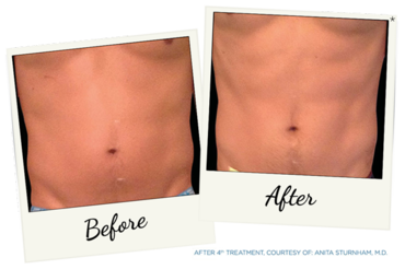 New York Cornea Consultants | Gentle reg  Hair Removal, Cataract Surgery and Keratoconus