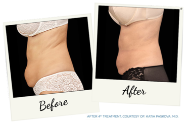 New York Cornea Consultants | Pterygium, PRP Hair Treatment and Emsculpt reg 