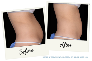 New York Cornea Consultants | Vampire Facial, Glaucoma and Keratoconus