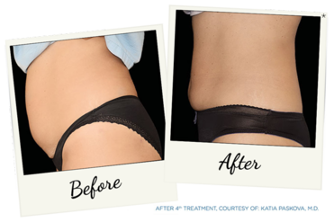 New York Cornea Consultants | Macular Degeneration, Dysport reg  and Cataract Surgery