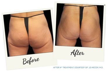 New York Cornea Consultants | Cataract Surgery, Keratoconus and Vampire Facial