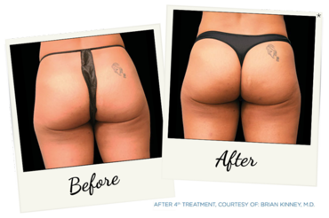 New York Cornea Consultants | Emsculpt reg , HydraFacial and Pterygium