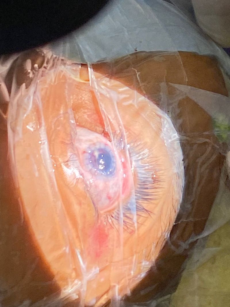 New York Cornea Consultants | Pterygium, Macular Degeneration and OMNI trade Glaucoma Treatment System