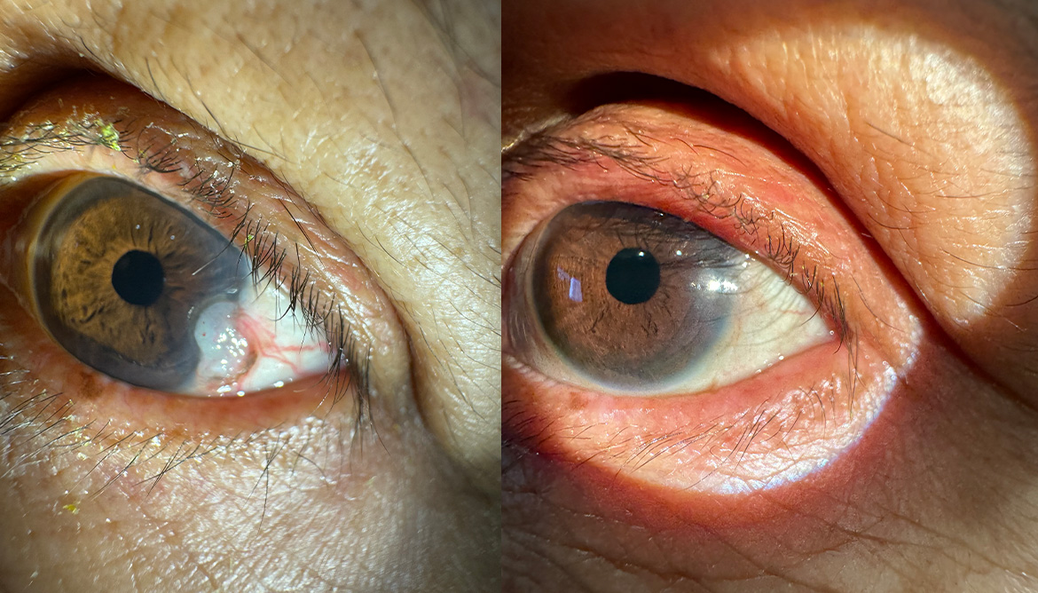 New York Cornea Consultants | Juveau reg , Cornea Transplant   Treatment and OMNI trade  Glaucoma Treatment System