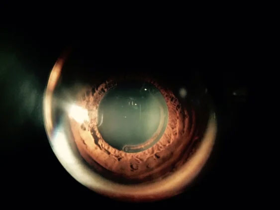 OEye Specialist 11361