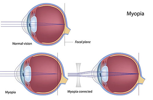 Myopia Treatment in Bayside