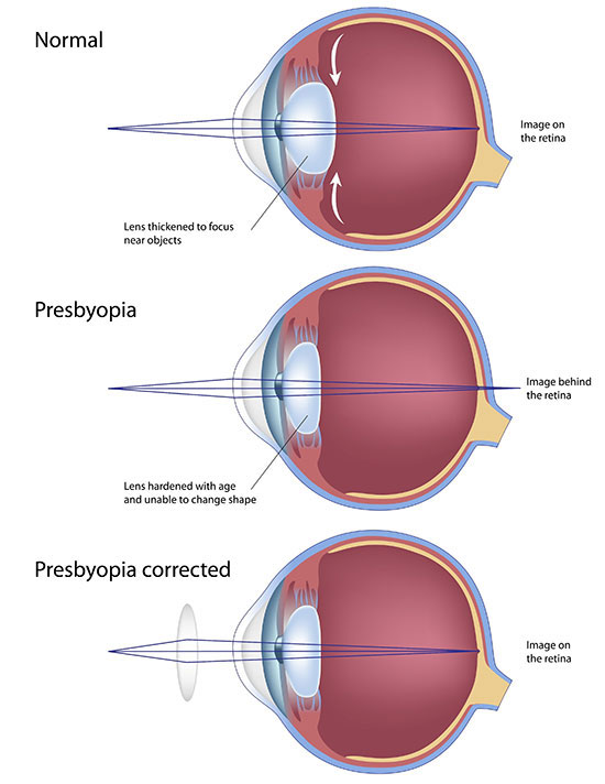 Presbyopia in Bayside